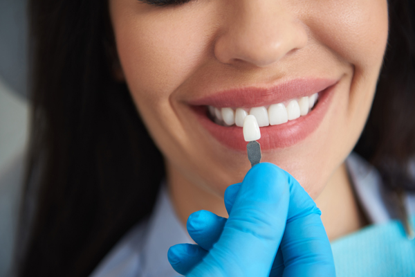 The Process Of Getting Dental Veneers: What To Expect